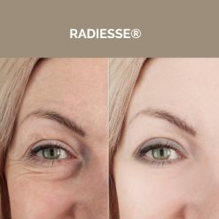 Radiesse®